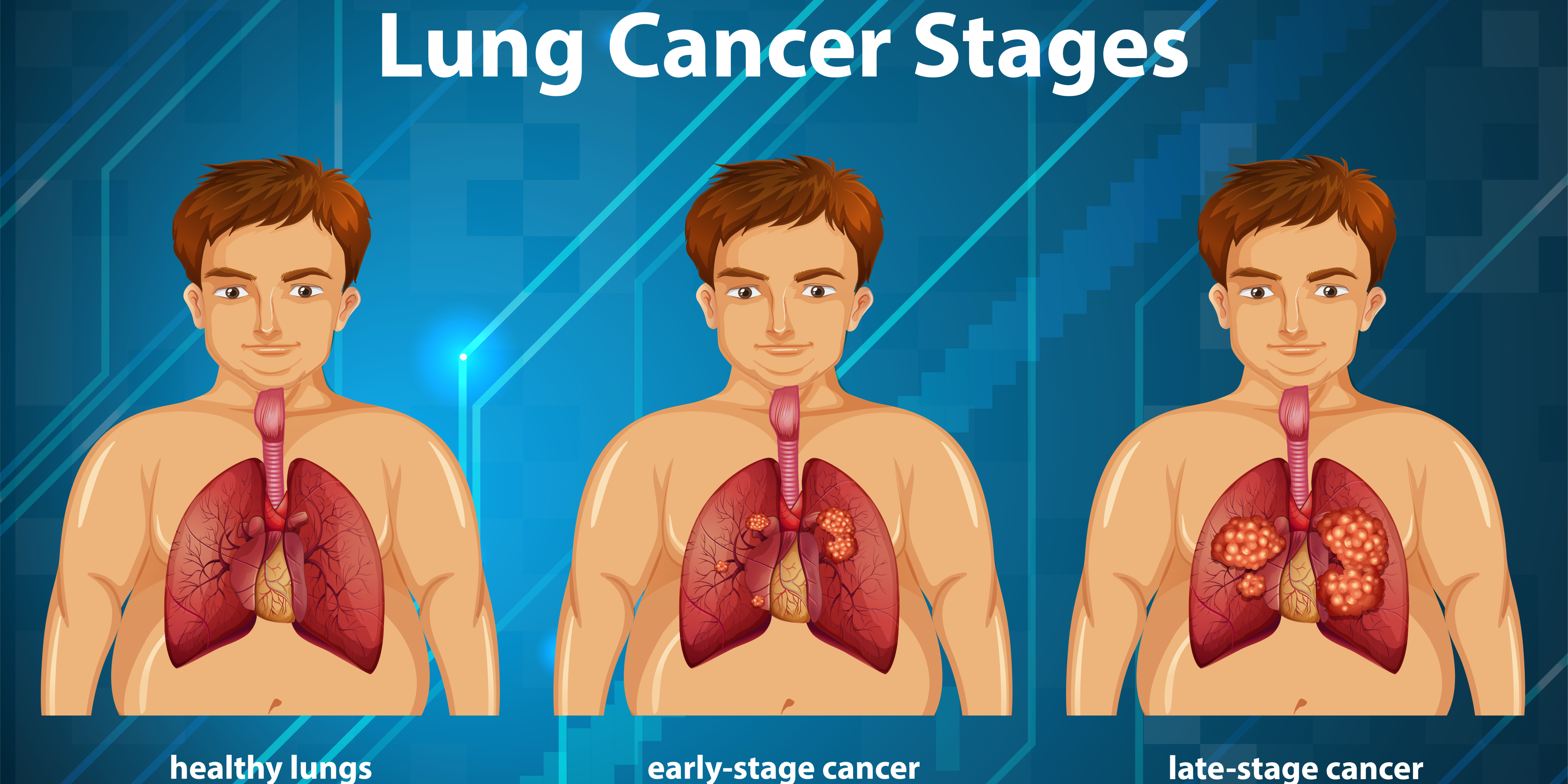 lung cancer specialist doctor